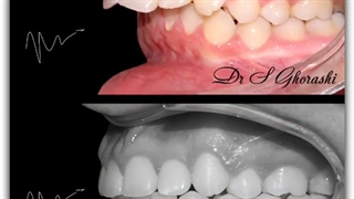 درمان یک بیمار با ناهنحاری کلاس ٢ با کشیدن از فک بالا | دکتر سعید قریشی
