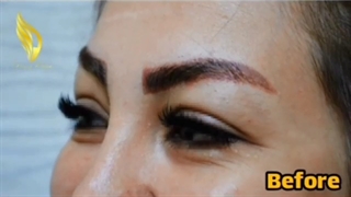 نمونه کاشت ابرو برای مراجعه کننده عزیز 