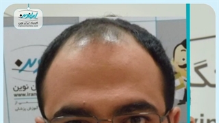 قبل و بعد کاشت مو