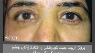 جراحی پروتز اربیت | پروفسور کشکولی | فوق تخصص جراحی پلاستیک چشم