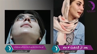 نتیجه فوق العاده جراحی بینی استخوانی