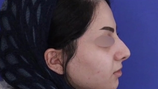 رفع مشکلات تنفسی و افتادگی بینی