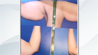 جراحی لیفت بازو ( براکیوپلاستی ) | فوق تخصص جراحی پلاستیک | دکتر عبدالرضا روئین تن