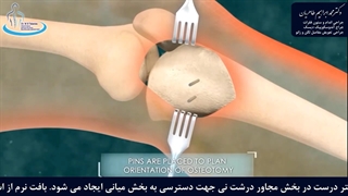 استئوتومی استخوان درشت نی برای اصلاح ساق پا | متخصص ارتوپد | دکتر محمد ابراهیم طاهریان لمینت