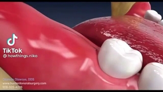 خارج کردن دندان عقل