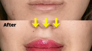 فیلم تزریق ژل به لب