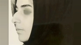 نمونه عمل بینی از دکتر احمد دانشی مربوط به 20 سال پیش