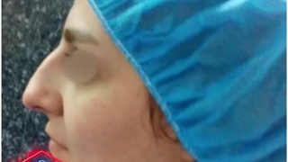 جراحی زیبایی بینی توسط دکتر احمد دانشی پالپوتومی