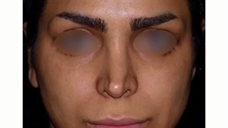 جراحی بینی ترمیمی با پیوند غضروف توسط دکتر ماریا مرادی