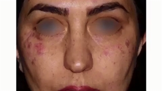 جراحی بینی توسط دکتر ماریا مرادی،بورد تخصصی جراحی گوش،حلق و بینی