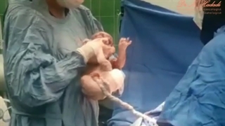 فیلم به دنیا آمدن بچه با زایمان سزارین