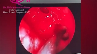 فیلم جراحی سینوس پیشانی با روش آندوسکوپی