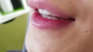 تزریق فیلر لب