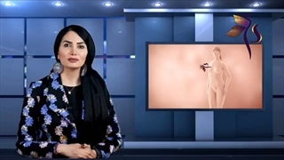 آندومتریوز و نازایی