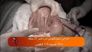 جراحی فیبروم رحم 1.5 کیلوی در دختر 27 ساله