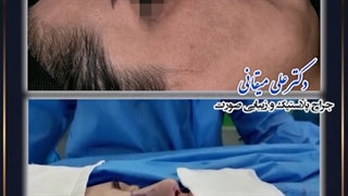 بلافاصله بعد از جراحی بینی | دکتر میقانی