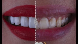 اصلاح طرح لبخند با استفاده از 10 واحد کامپوزیت ونیر فک بالا | دکتر حامد صالحی