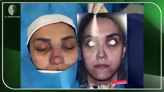 جراحی بینی ترمیمی با سختی بسیار زیاد | دکتر باستانی نژاد