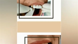 نتیجه درمان ترکیبی لمینت سرامیکی imax