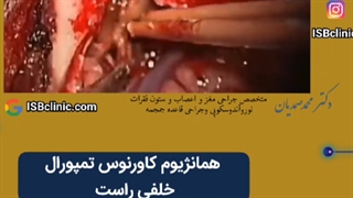 همانژیوم کاورنوس تمپورال خلفی راست