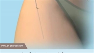 نحوه جراحی لیپوماتیک ران