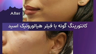 کانتورینگ گونه با فیلر هیالورونیک اسید