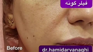 فیلر گونه توسط دکتر حمید ارونقی