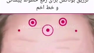 مناسب ترین نقاط تزریق ژل و بوتاکس
