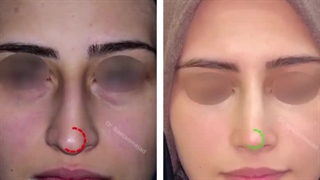 شش ماه بعد از جراحی بینی با پوست ظریف | دکتر باستانی نژاد
