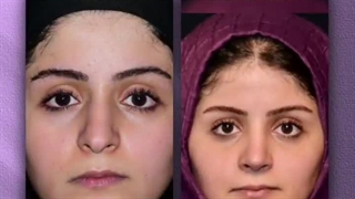 جراحی بینی طبیعی زنانه | دکتر رفیع | جراح بینی تهران