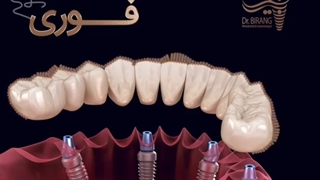 صحبت های دکتر بیرنگ در مورد ایمپلنت فوری