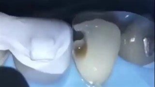 ترمیم پوسیدگی دندان