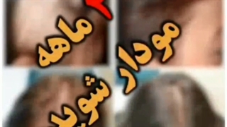 قطع ریزش مو تنها در 4 جلسه!