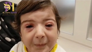 درمان کودکی با مشکل مادرزادی اسپاسم عضلات پلک و اطراف دهان