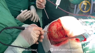 جراحی تومور مغزی در بیمار چهل ساله