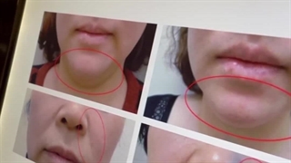 هایفوتراپی جوانسازی وپاکسازی وزیبایی صورت بدون جراحی اندودنتیکس