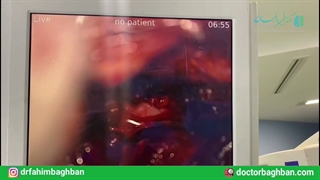 عمل جراحی میکروسکوپیک دیسک کمر