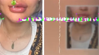 فیلم تزریق ژل گونه، چانه، خط فک و لب