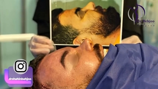 فیلم واقعی لیفت ابرو با آندوسکوپی