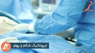 لیپوماتیک شکم و پهلو