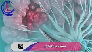 بیوپسی سوزنی پستان