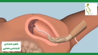 خارج کردن جفت با دست-کورتاژ