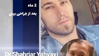 دو ماه بعد از جراحی بینی | دکتر یحیوی