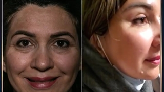 یک ماه بعد از لیفت پیشانی و قسمت میانی صورت با اندوتاین | دکتر میقانی