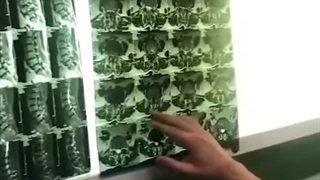 تنگی کانال نخاع | دکتر اشکان خواجو