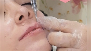 دکتر علیزاده تهران تزریق ژل و چربی درمان سلولیت