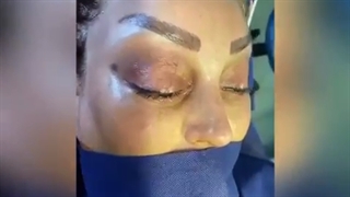 لیفت اندوسکوپی به کمک اندوتاین