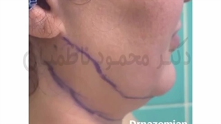 لیپوی غبغب سه ماه بعد از جراحی