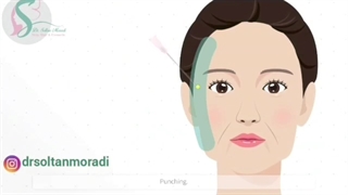 فیلم لیفت صورت با نخ!!!