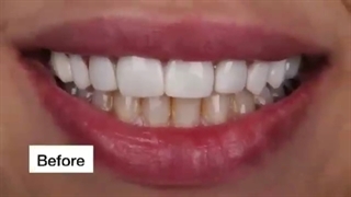 لمینت دندان